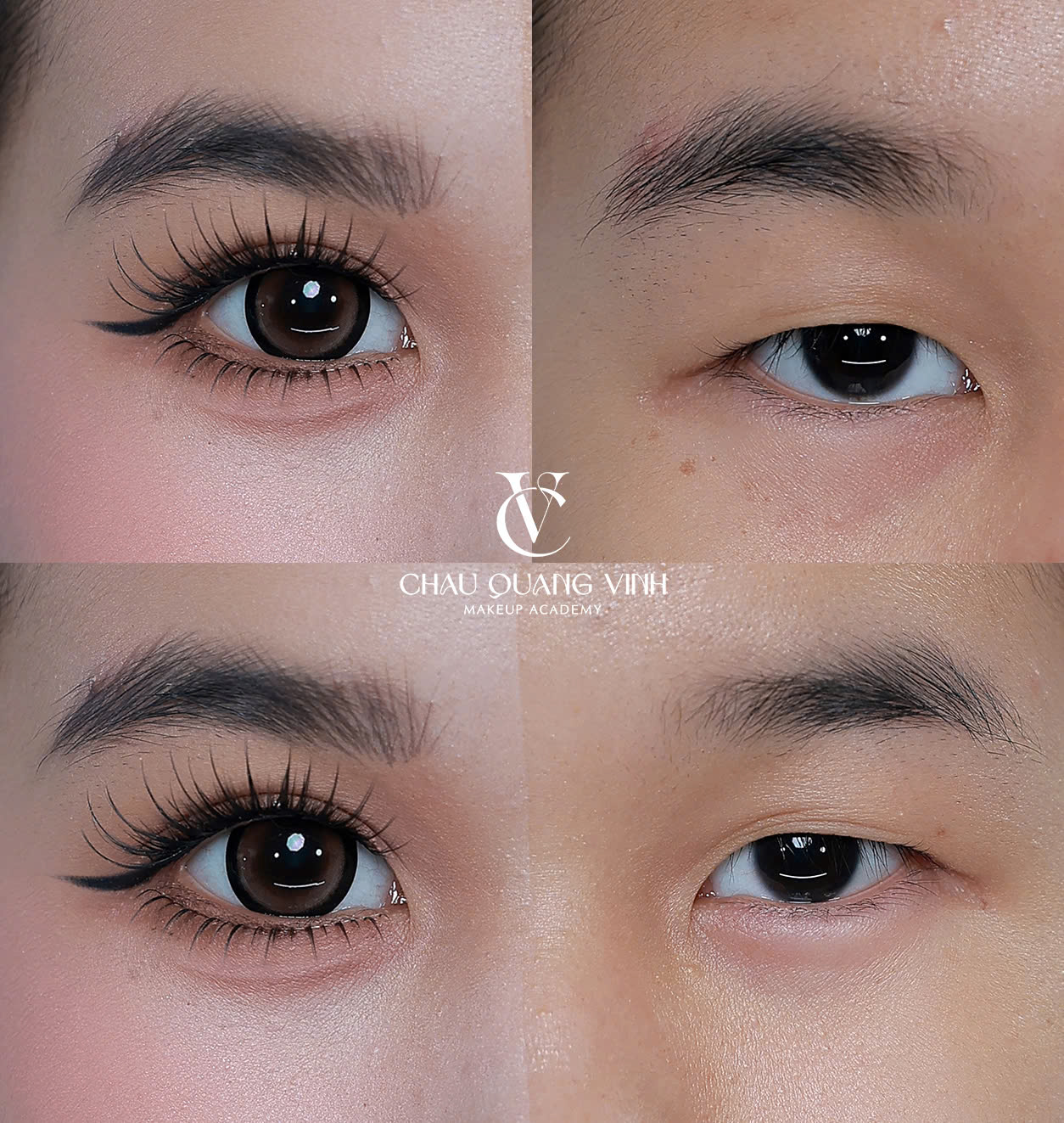 Before after mắt