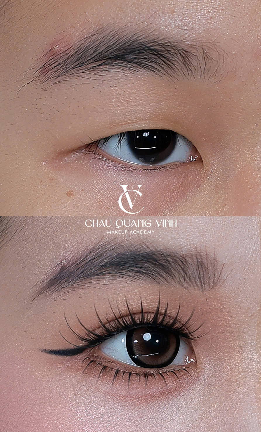 Before after mắt