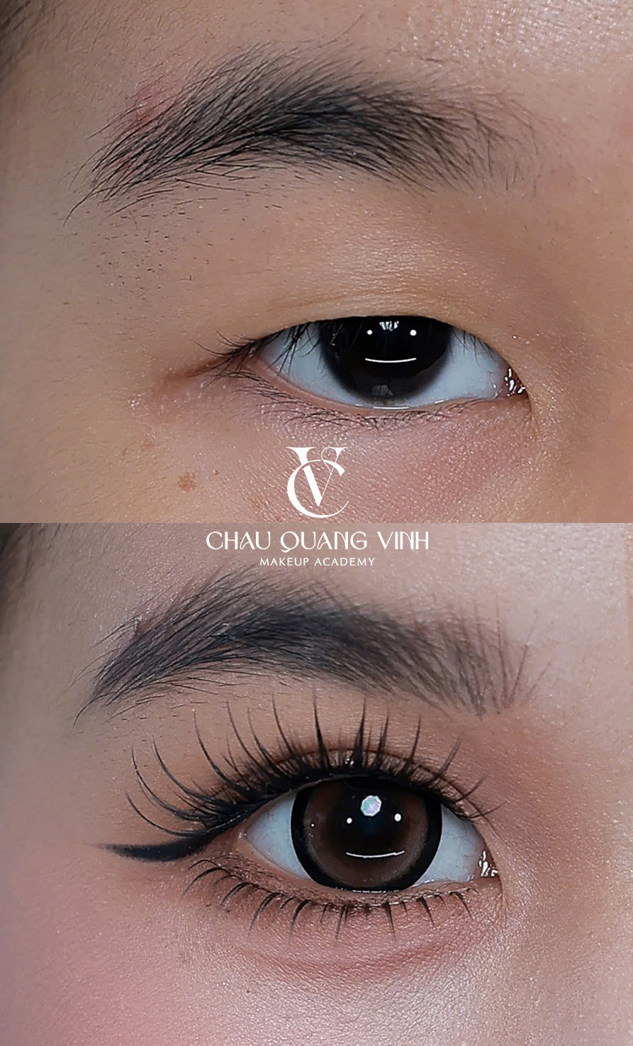 Before after mắt